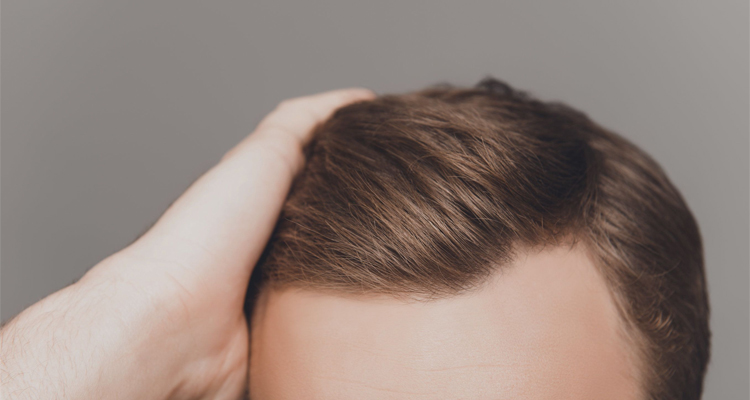 Hair Transplant In Turkey - istanbul clinic